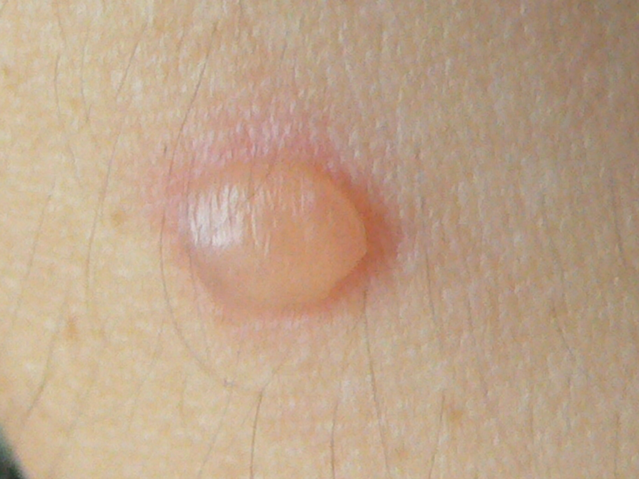 Breastfeeding Blister